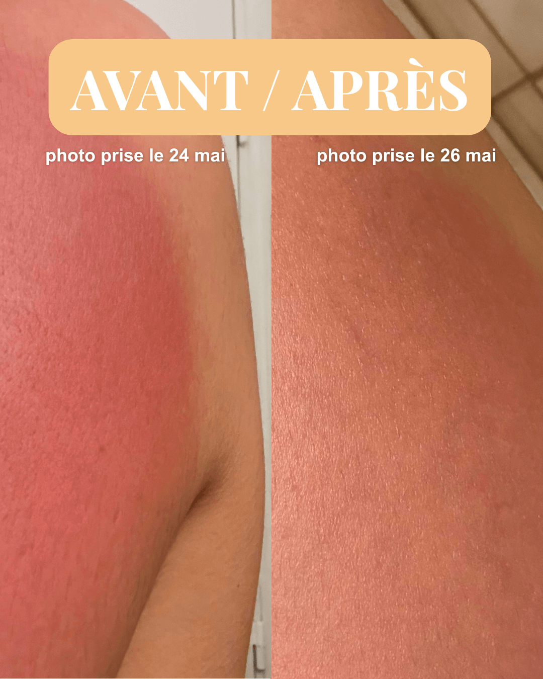Pour peaux irritées & coups de soleil, à l'Immortelle - Huile réparatrice