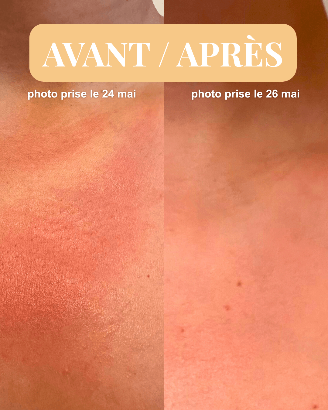 Pour peaux irritées & coups de soleil, à l'Immortelle - Huile réparatrice